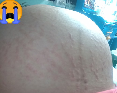 ผื่นคัน