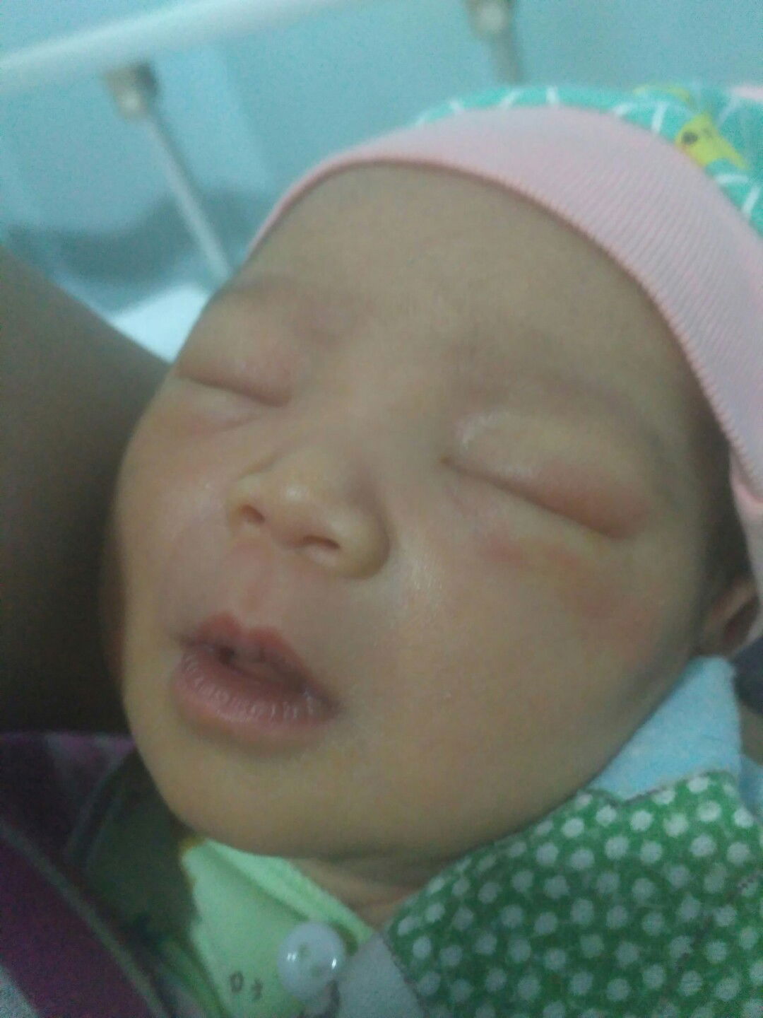 mata bayi agak sembab dan belekan