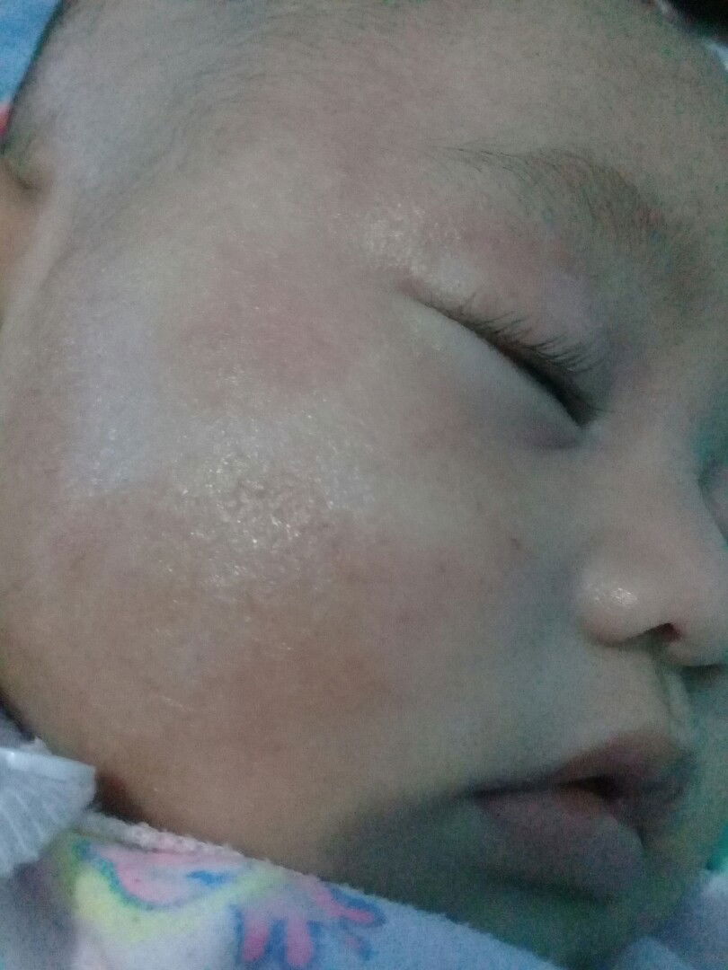 kulit kering, kaku dan ruam