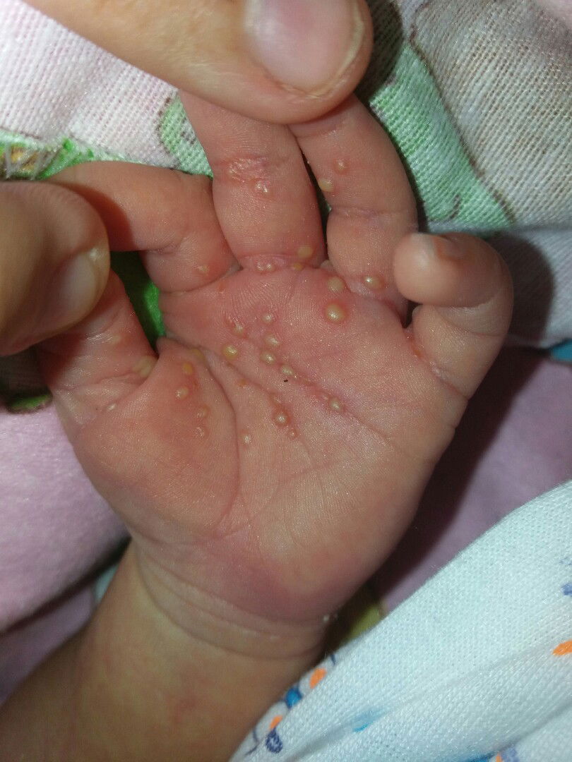 biang keringat tapi seperti ada nanah