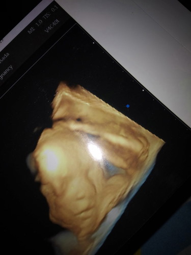 Mana foto usg anak bunda