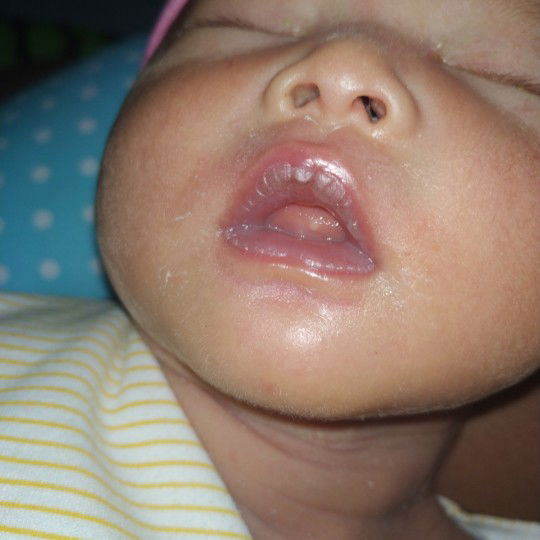 Bintil Putih Pada Lidah