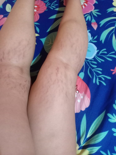 Stretch marks