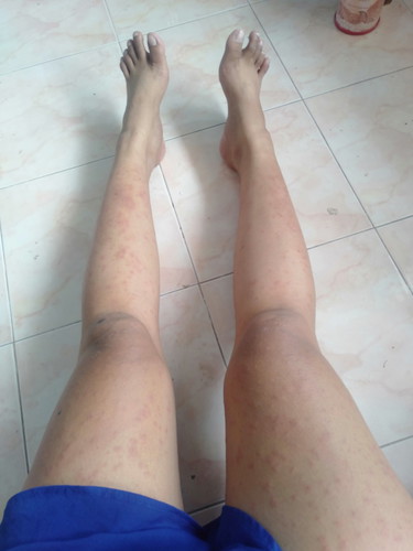 ผื่นคัน