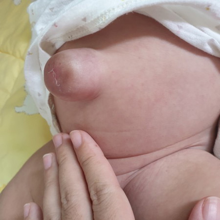 สะดือปูดมาก