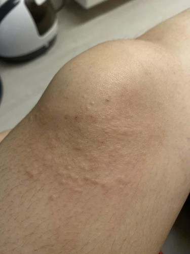 Itchy bumps