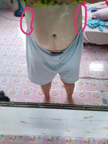 เจ็บท้องซ้ายขวา