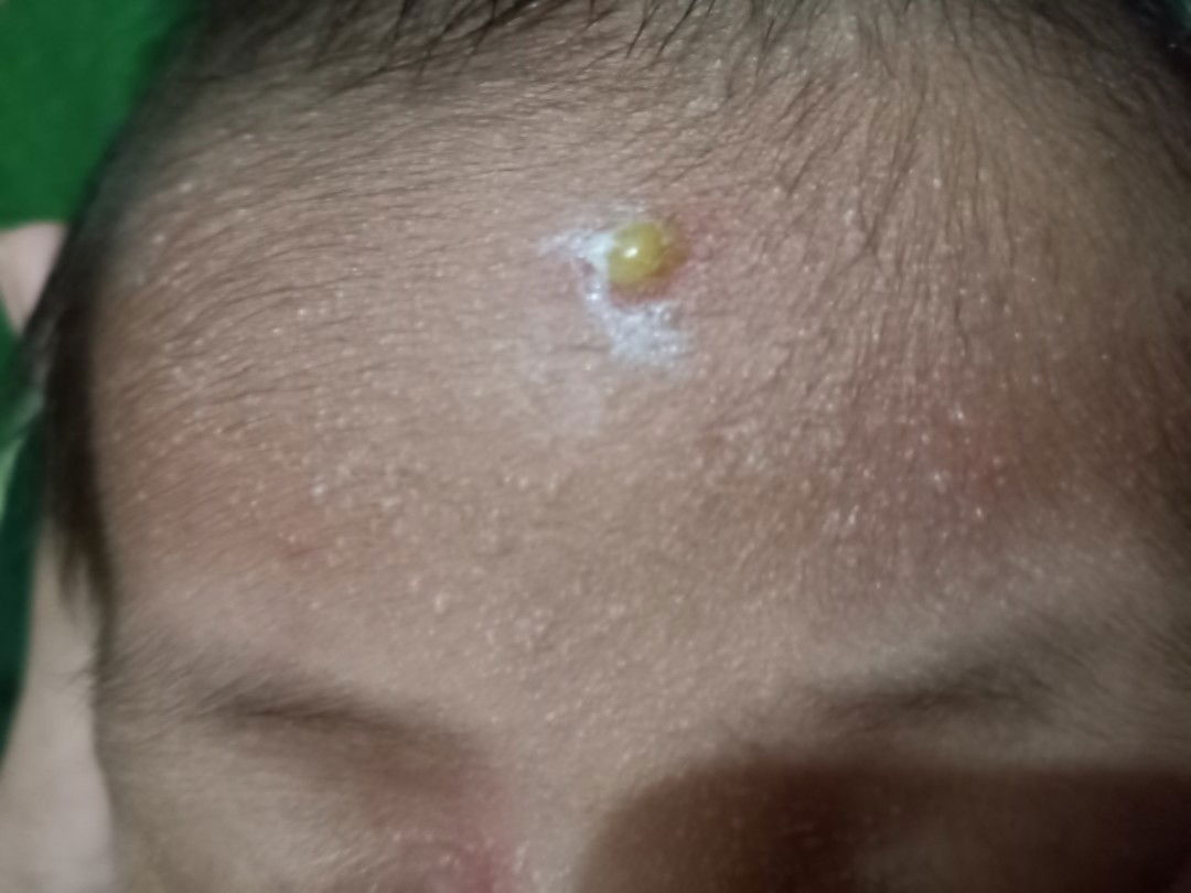 benjolan di dahi bayi