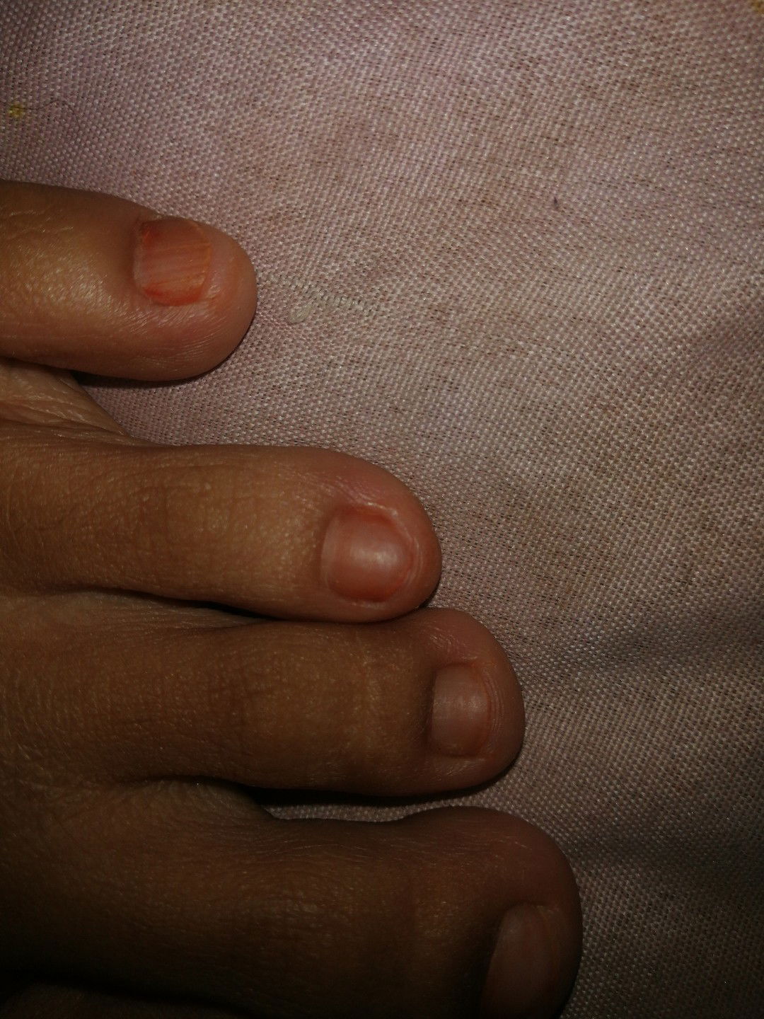 perubahan warna kuku pada kaki