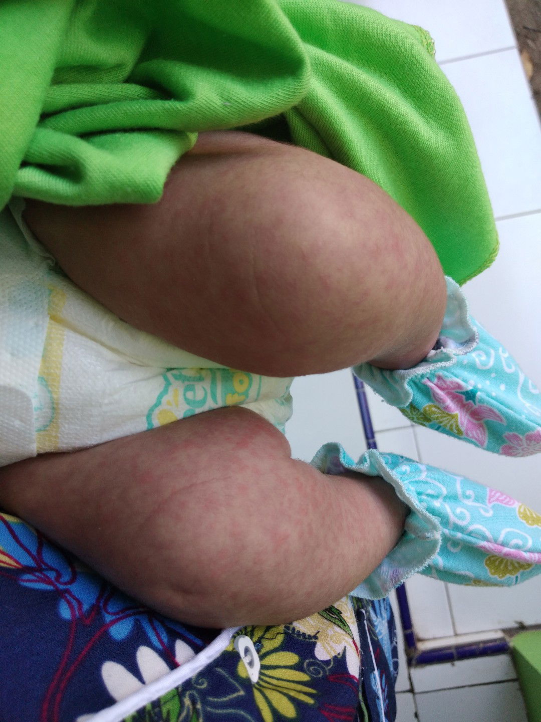ruam merah2 seluruh tubuh bayi