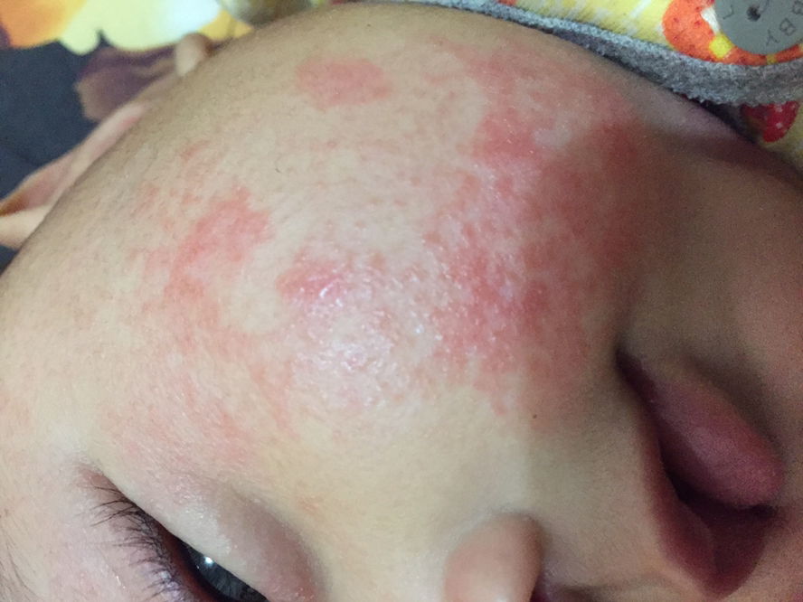 Ruam pipi / kulit pipi merah-merah /
