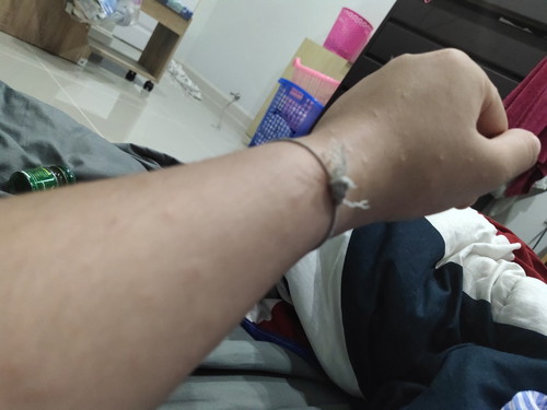 เป็นตุ่มคันสีใสขึ้นเต็มตัว 32w