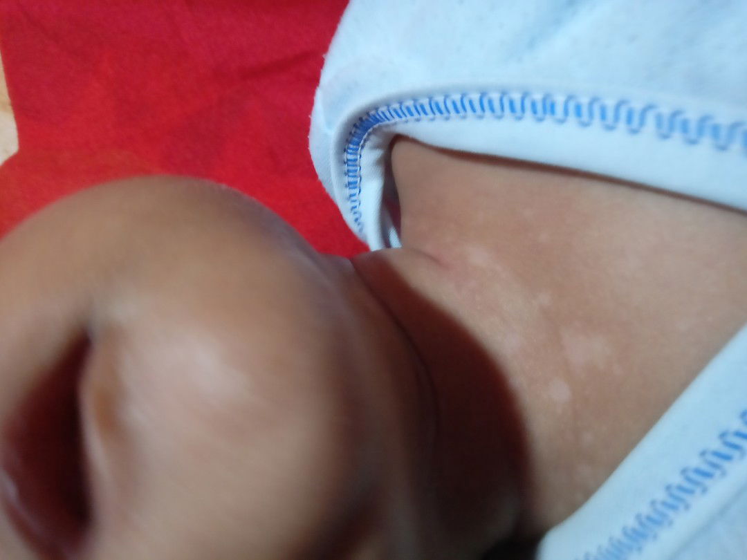 bintik Putih2 dileher