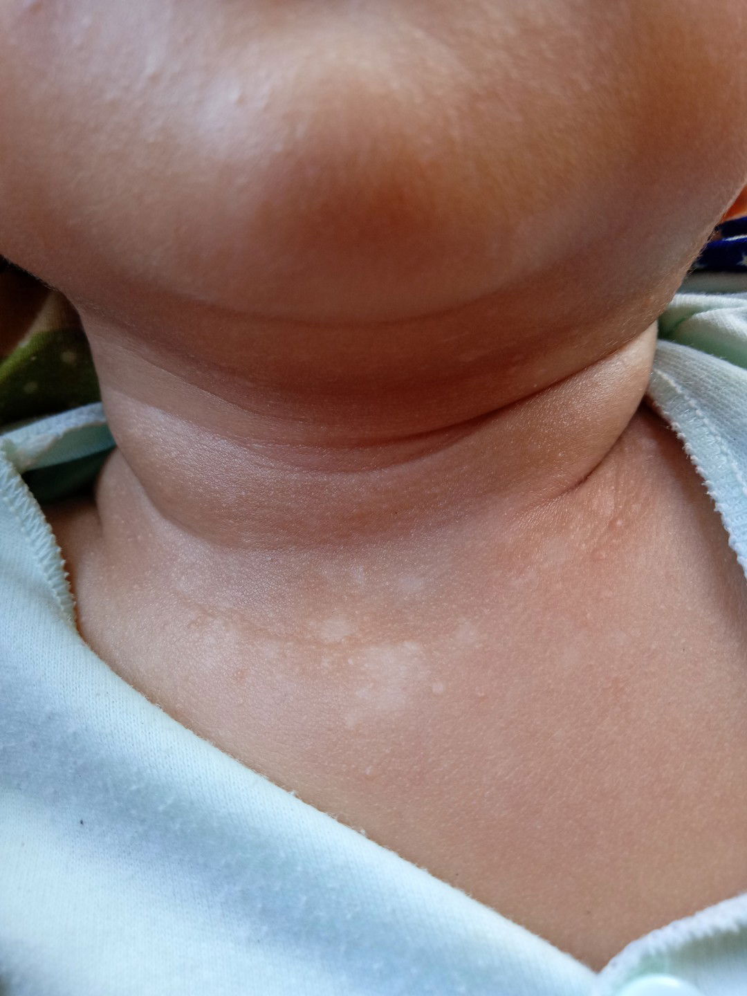 bercak putih dileher anakku