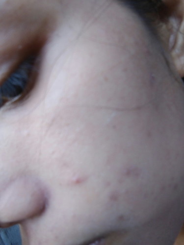 Dry Skin