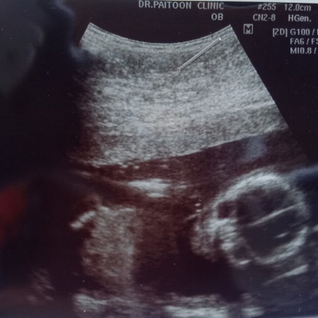 18w2d