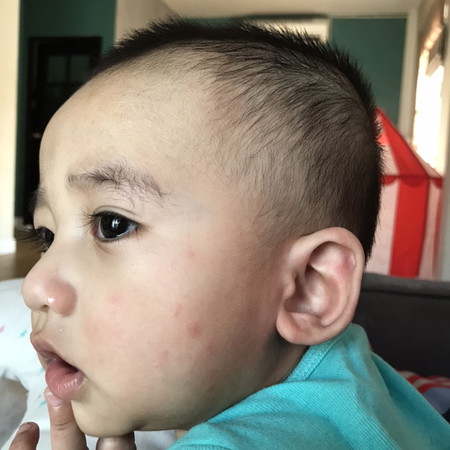 ลูกขึ้นผื่นเม็ดๆ