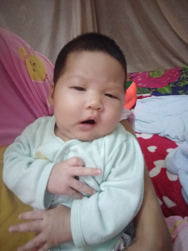 ลูกคัดจมูก