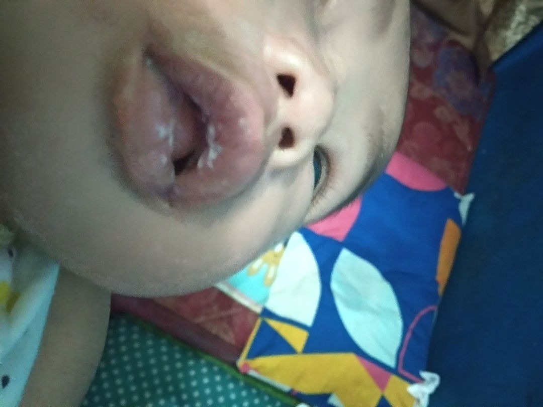 sariawan dimulut bayi