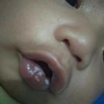 sariawan bayi di mulut