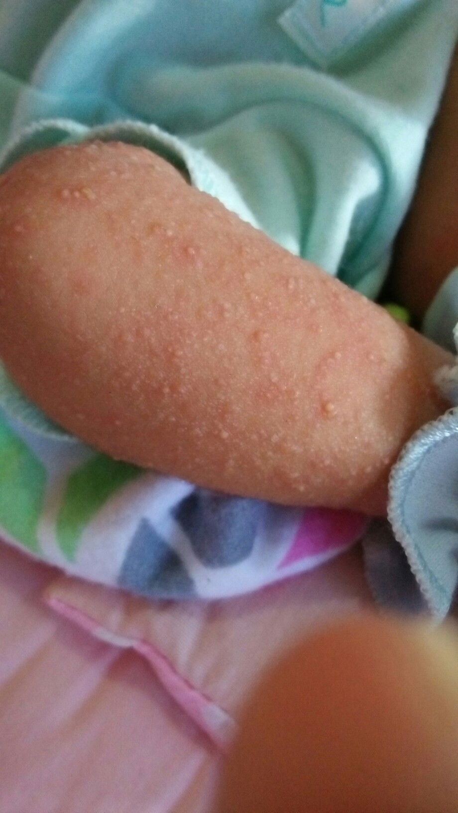 alergi atau biang keringat?