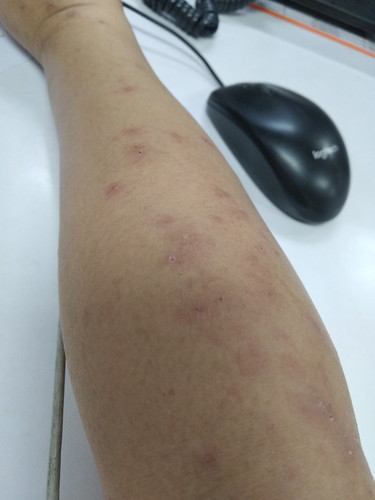 Ruam Gatal atau Chicken Pox?