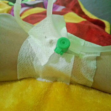 akhirnya kuret untuk kedua kalinya