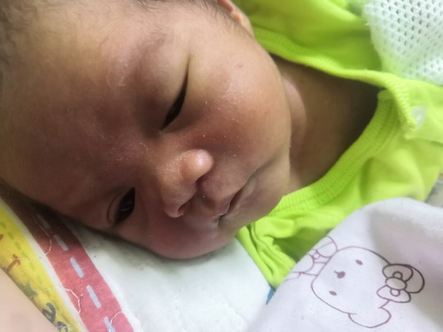 Mata Bayi Bengkak Sebelah