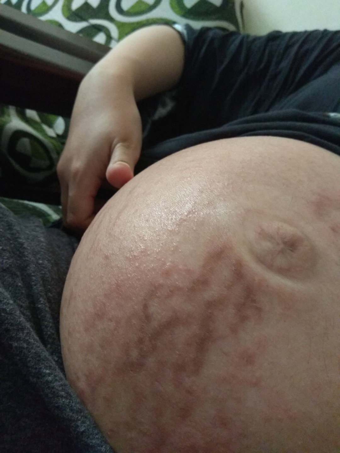 stretch mark dan beruntusan di trismester 3