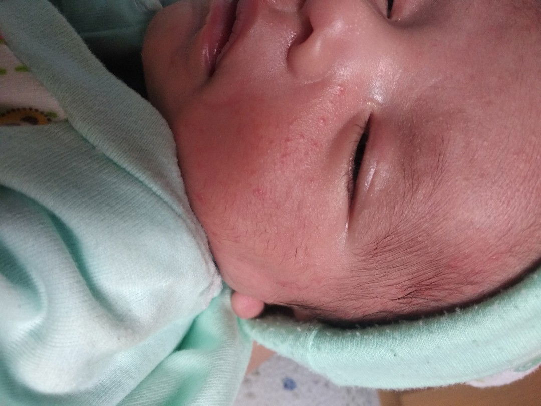 cara ilangin bruntusan di wajah bayi