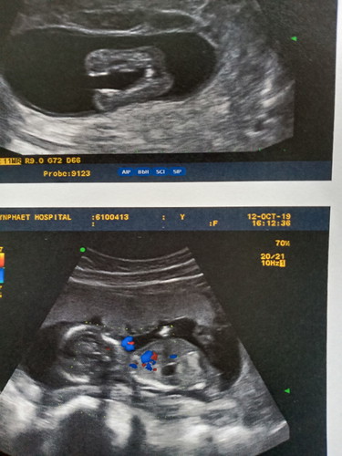 วันจันทร์หมอนัดซาวเพศแล้วค่ะ