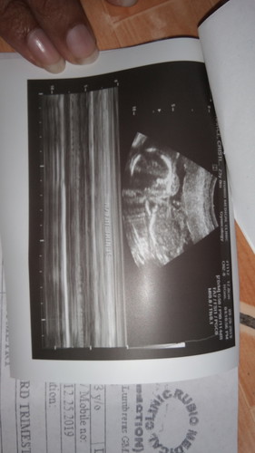 ask kulang poh baby twins ko walng heartbeat yong isang baby ano kaya gagawin sakin ng doctor