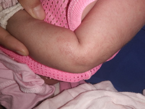 ควรใช้ครีมอะไรไหมค่ะหรือปล่อยให้หายไปเอง