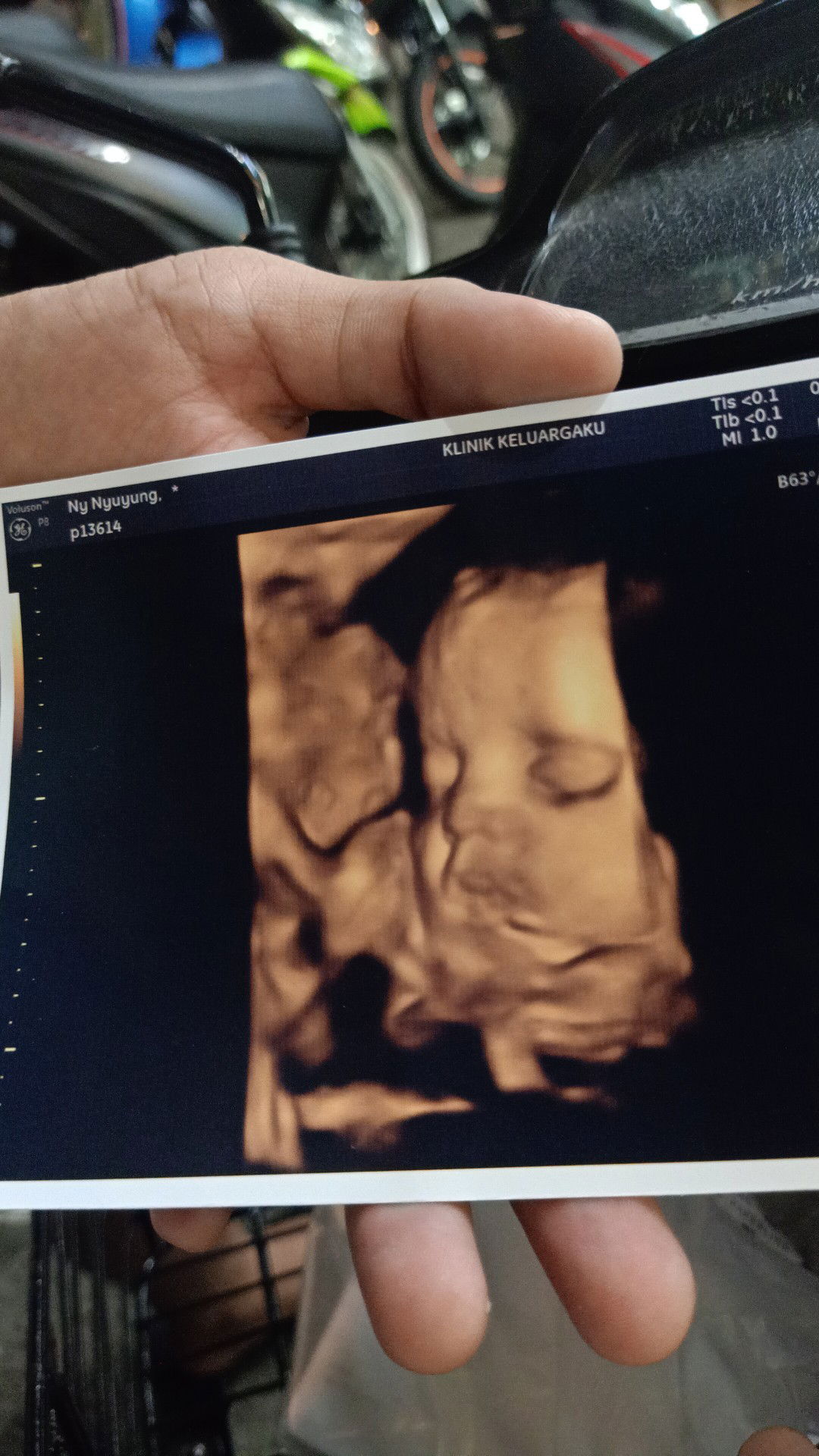 29 week kepala belum kebawah