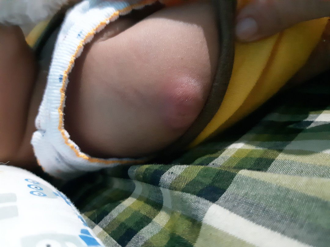 bekas suntik imunisasi