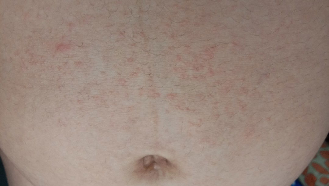 bintik"merah dan gatal