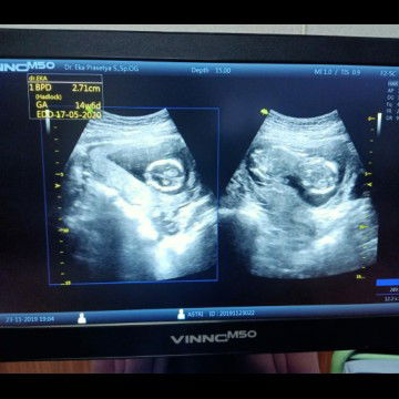 Msh blm ngrti gmna cek usg