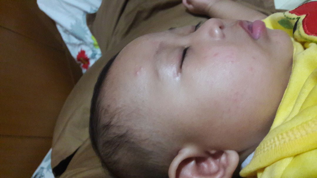 ruam di pipi, lipatan leher dan badan