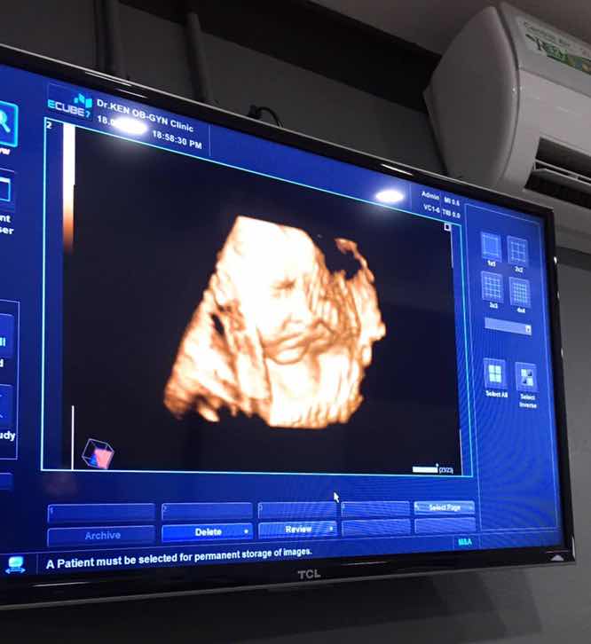 อัลตร้าซาวด์