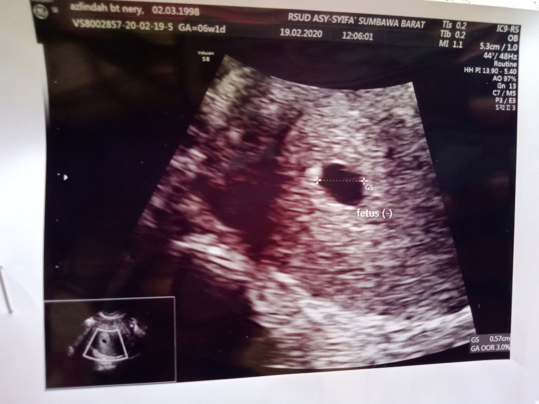 kehamilan 6week 1 day