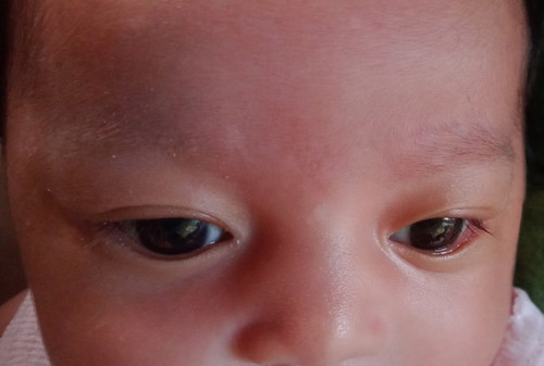 bercak putih