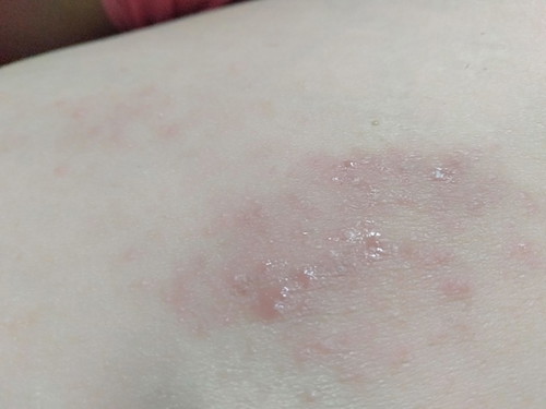 ตุ่มคันหรือเป็นเชื้อราค่ะ