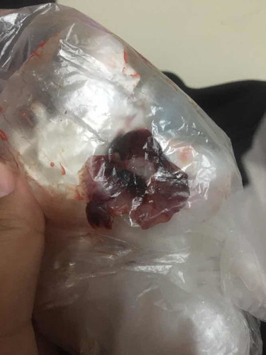 คลอดน้อง3เดือนมีเลือดออกเป็นก้อน