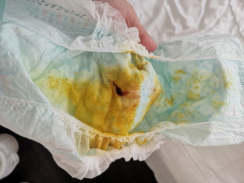 Blood In Poop