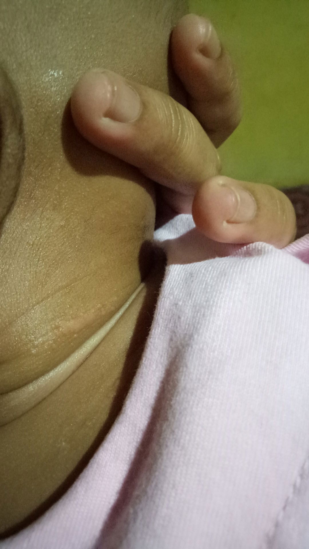 penyakit kulit pada bayi