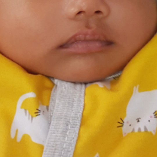 bibir bayi 1 bulan pecah pecah