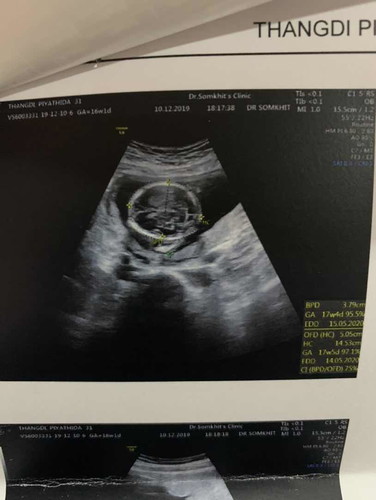 น้ำในสมอง