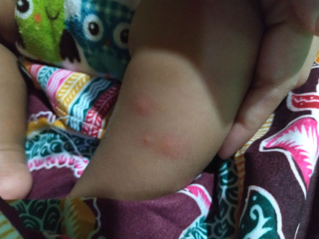 bentol merah pada kulit bayi