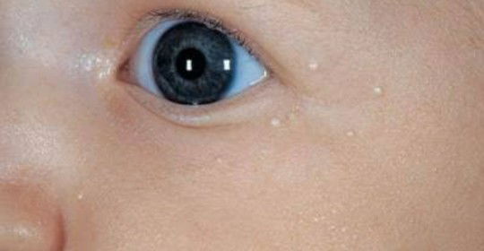 bintik putih pada wajah bayi