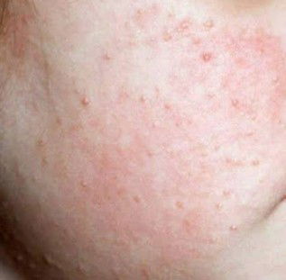 pipi ruam/ bintik" merah